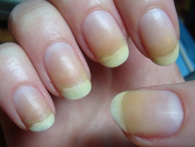 5 Home Remedies for Yellow Nails