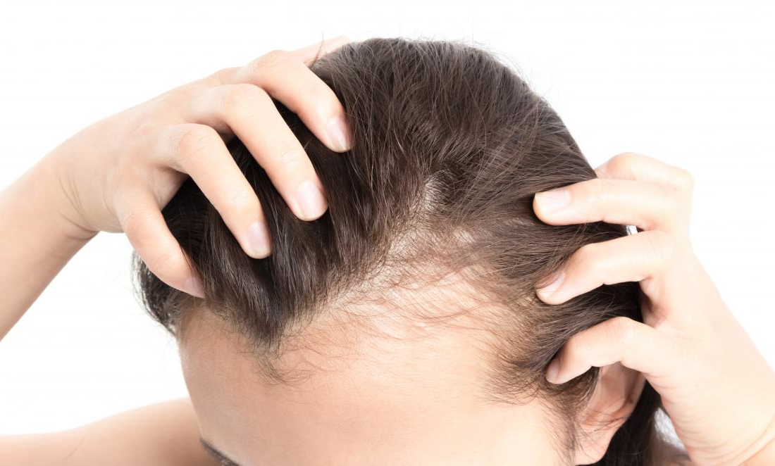 Excessive Hair Loss and Diseases - MakeupYes