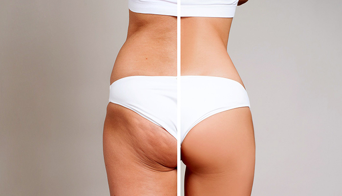 Five Easy Steps to Beating Cellulite