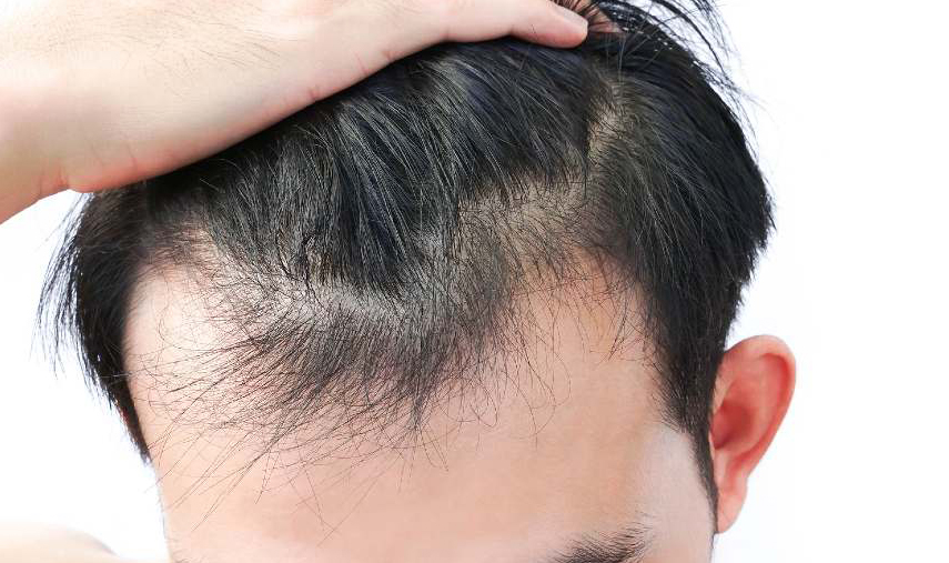 Five Ways to Stop Male Pattern Baldness