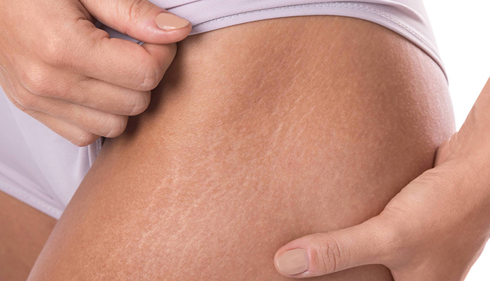 How to Get Rid of Stretchmarks